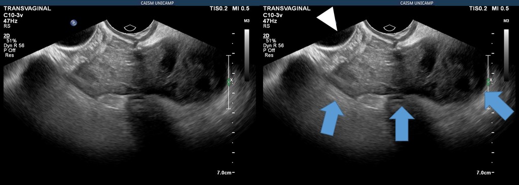 Hematoma Em Cúpula Vaginal Em Pós Operatório De Histerectomia Dr Pixel 9153